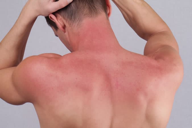 Man With Sunburn