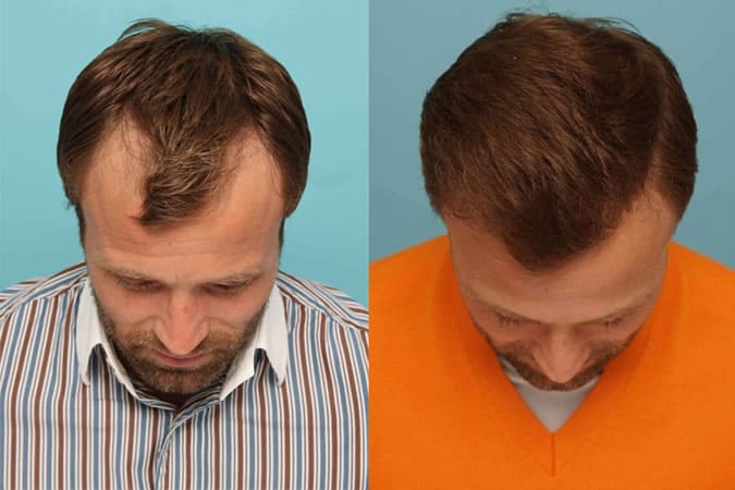 Hair Transplant