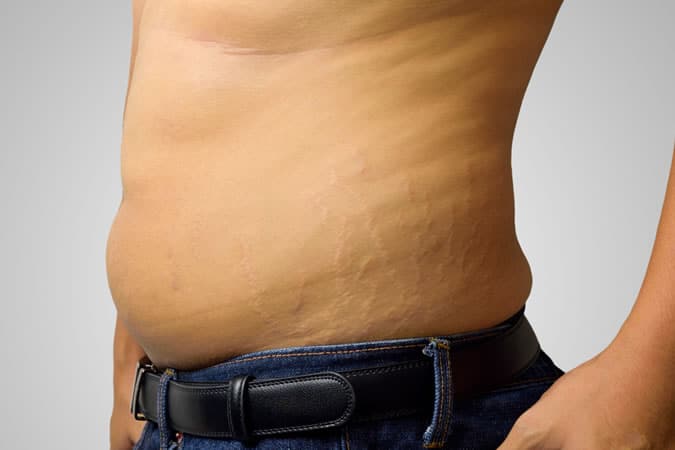 Male Stretch Marks