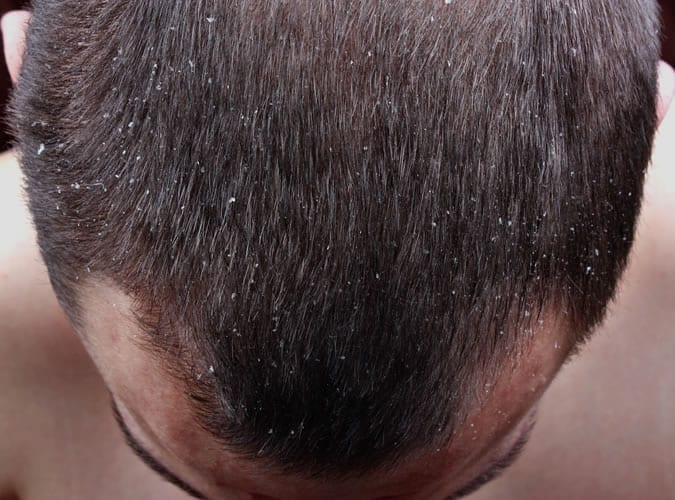 Dandruff