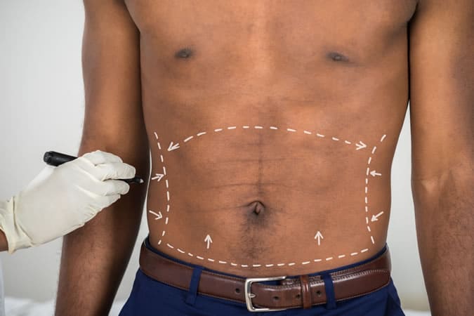 Liposuction