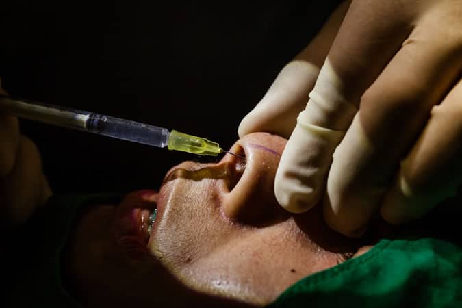 Rhinoplasty