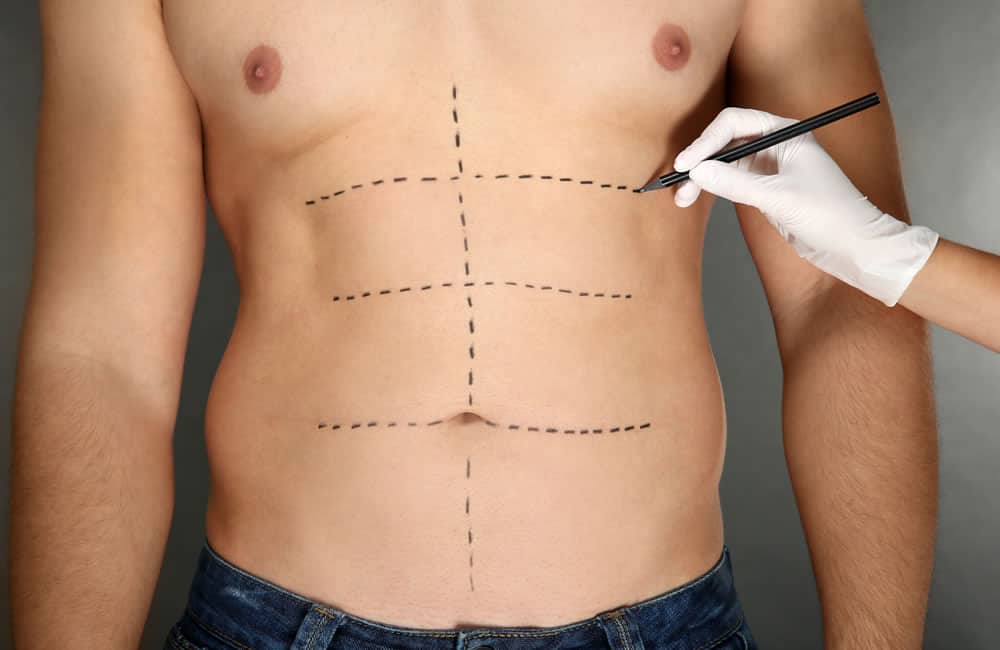 Man getting body cosmetic surgery