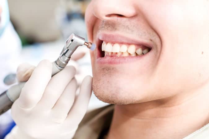 Teeth Whitening