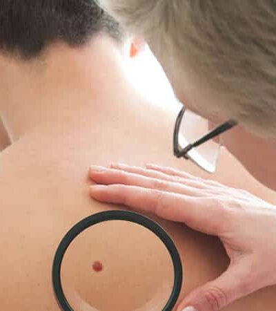 Why It’s Time To Get Serious About Skin Cancer