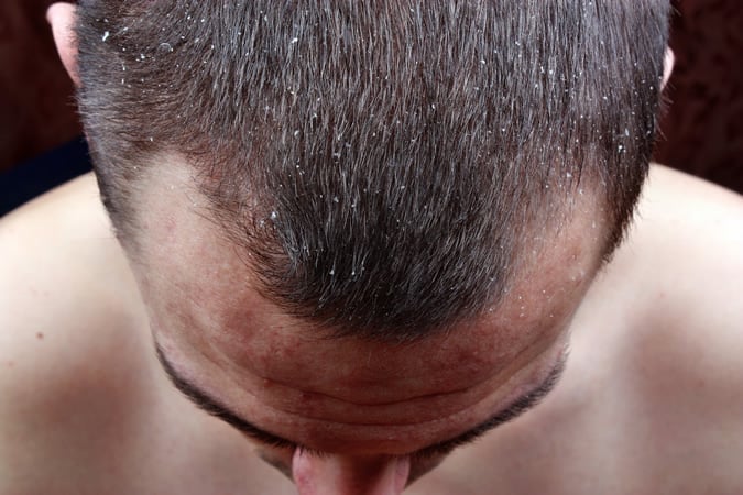 Man With Dandruff