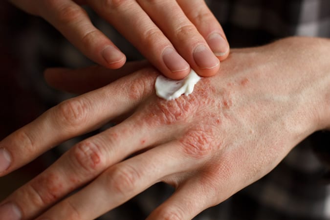 Eczema On The Hands