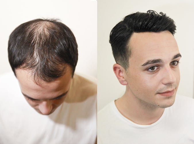 Hairweaveon Before After