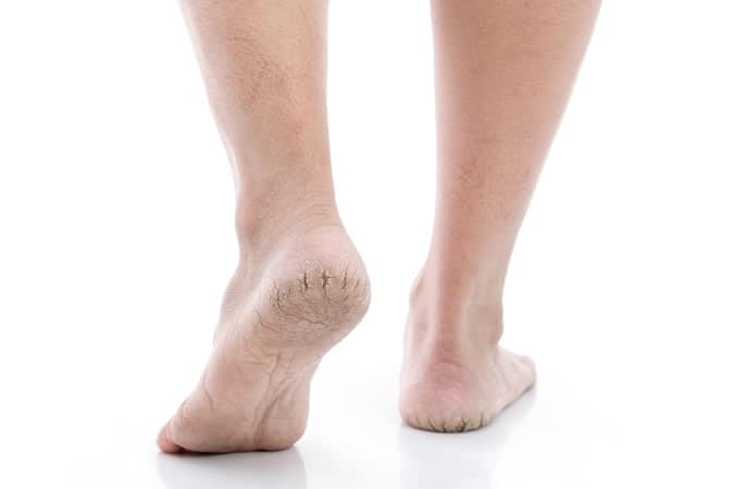 Cracked Dry Feet