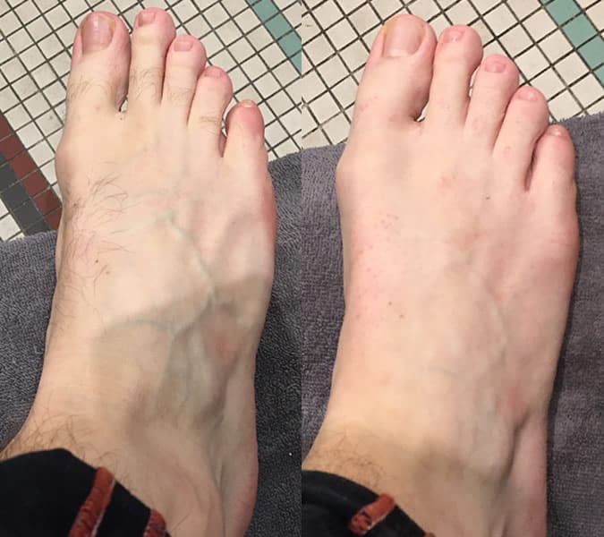 Before and after a pedicure