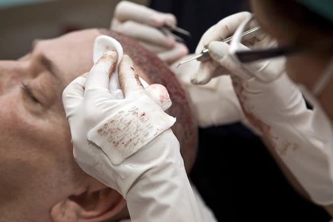 Hair Transplant