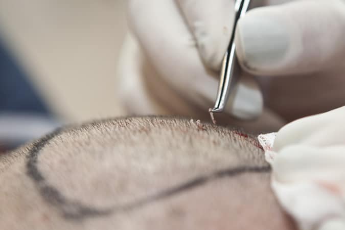 Hair Transplant