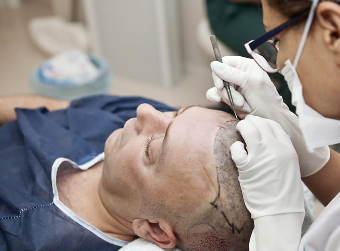 Hair Transplant
