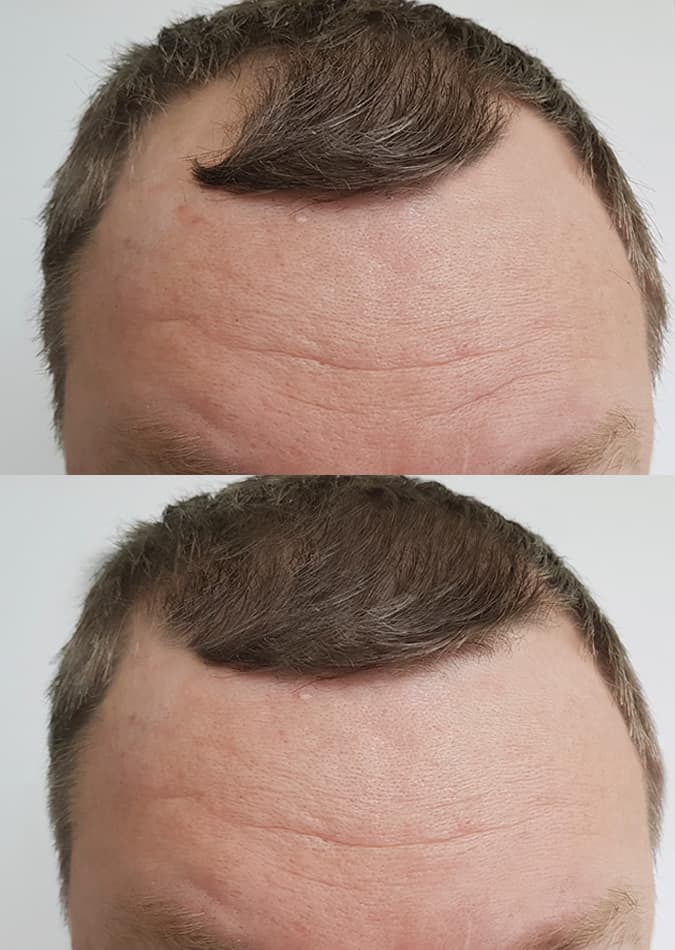Hair Transplant before and after