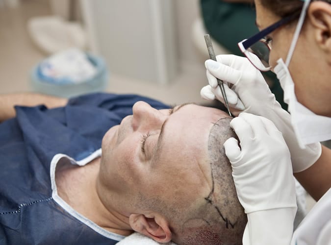 Hair Transplant Procedure