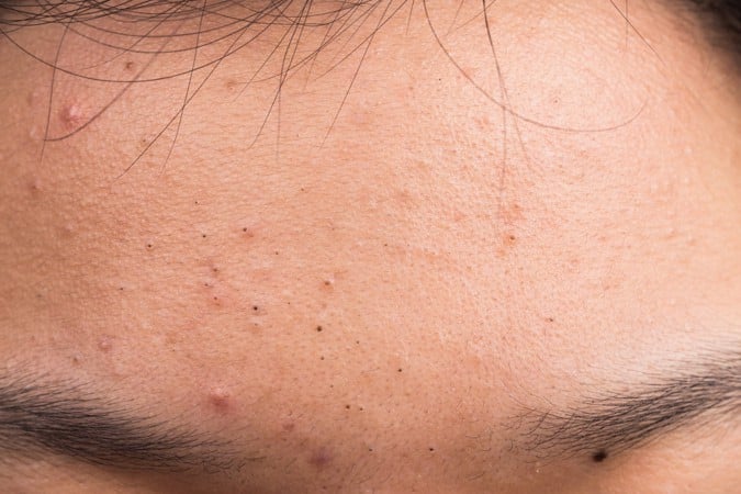 Acne