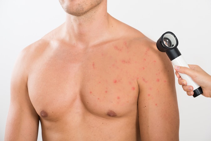 Acne Scars